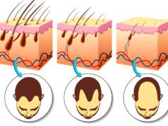 Fases da alopecia androgenética