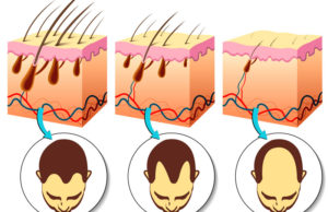 Entenda o que é a alopecia androgenética Fases da alopecia androgenética