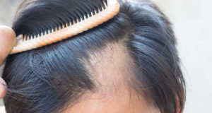 alopecia-areata
