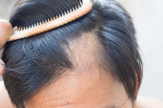 alopecia areata alopecia-areata