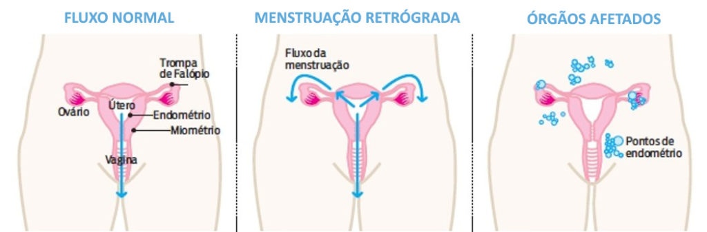 endometriose endometriose