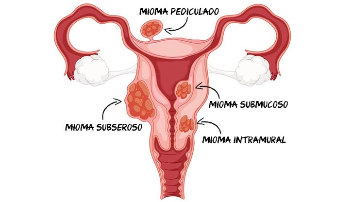 Como tratar miomas como-tratar-miomas
