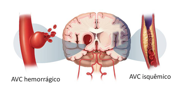 Tipos de avc tipos-de-avc