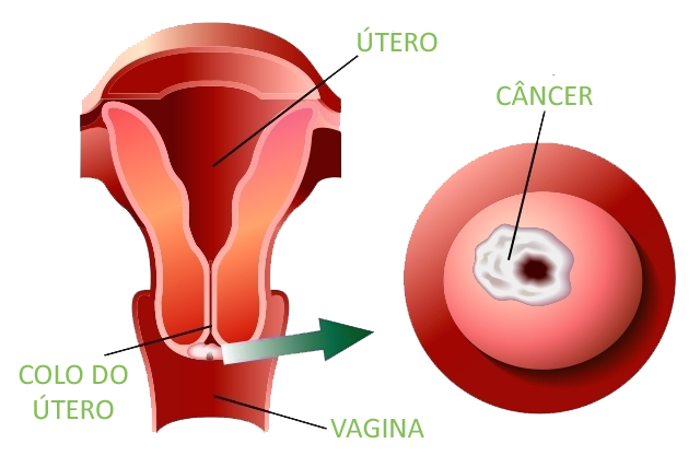 Câncer no colo do útero cancer-no-colo-do-utero
