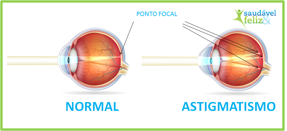 Astigmatismo e a miopia astigmatismo-e-a-miopia