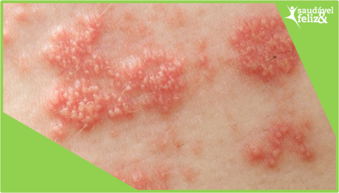 Manchas na pele na menopausa herpes manchas-na-pele-na-menopausa-herpes