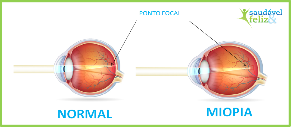 Astigmatismo e a miopia astigmatismo-e-a-miopia