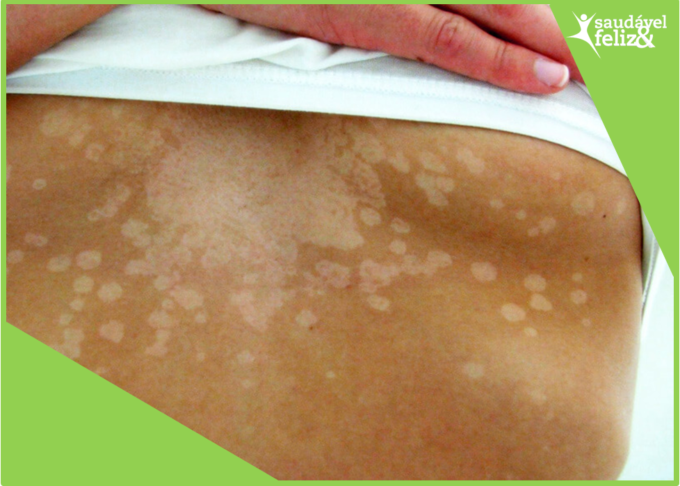 Manchas na pele na menopausa pano branco manchas-na-pele-na-menopausa-pano-branco