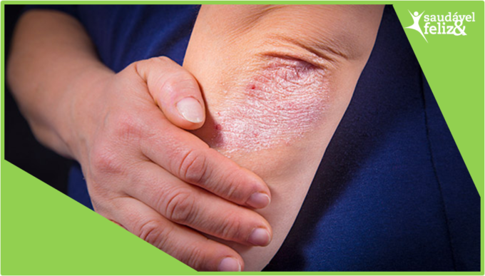 Manchas na pele na menopausa psoriase manchas-na-pele-na-menopausa-psoriase