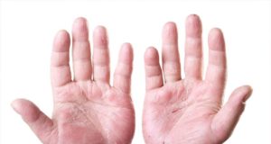 Psoriase
