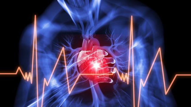 angina