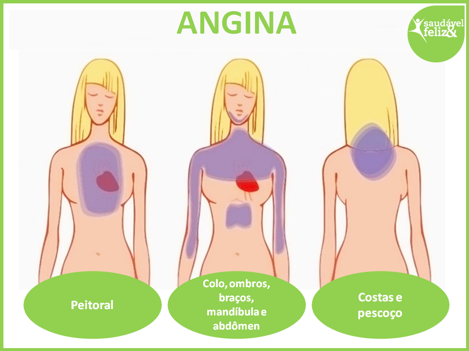 Angina angina