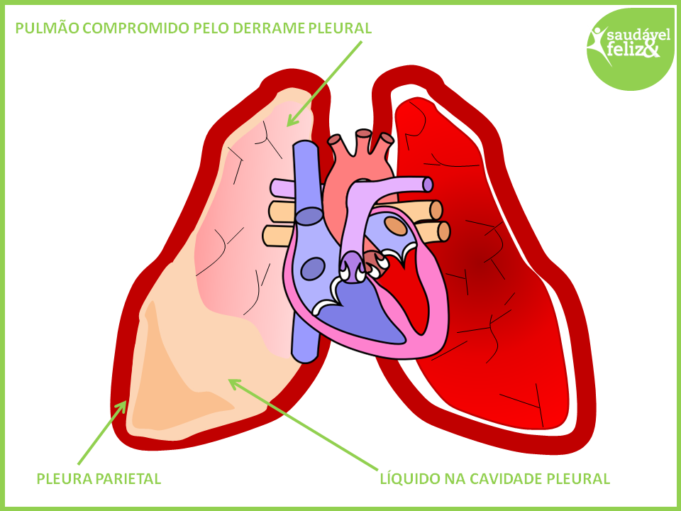 Como tratar a água no pulmão? Água no pulmão