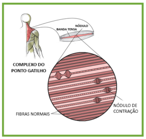 Síndrome Miofascial sindrome-miofascial