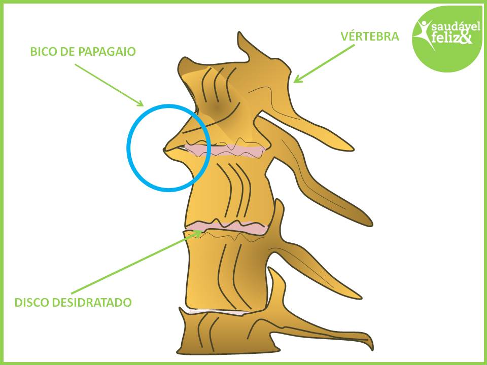 Tratamento para bico de papagaio tratamento-para-bico-de-papagaio