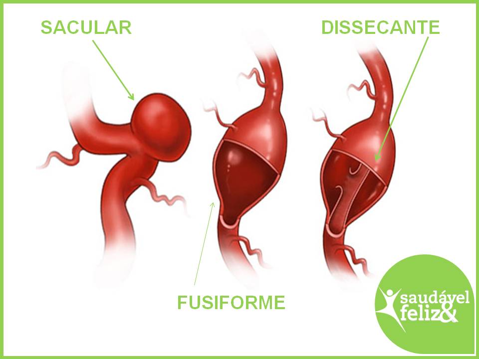 Tipos de aneurismas aneurisma