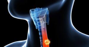 cancer-de-esofago