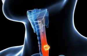 cancer-de-esofago