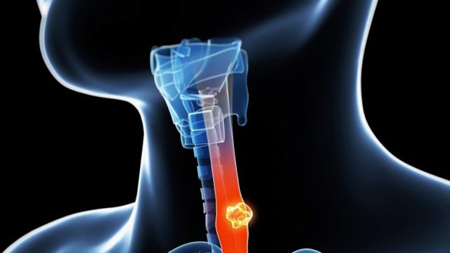 cancer-de-esofago