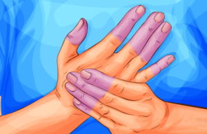 sindrome-de-raynaud