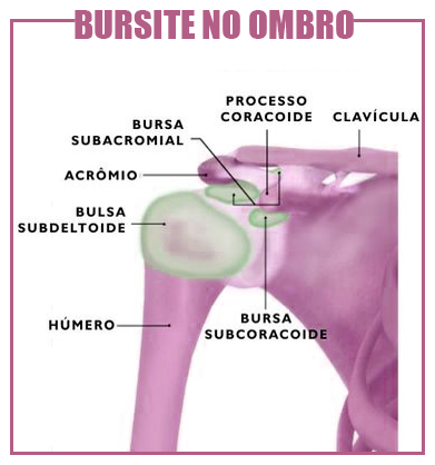 Bursite no ombro