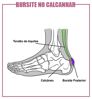 bursite no calcanhar bursite no calcanhar