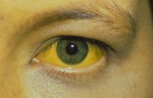hepatite-alcoolica