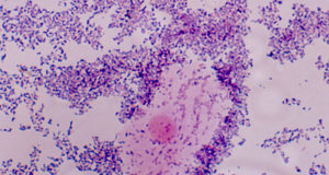 vaginose-bacteriana