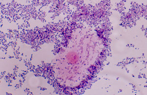 vaginose-bacteriana