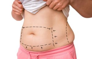 Prós e contras da cirurgia bariátrica: tudo sobre a redução de estômago! cirurgia-bariatrica
