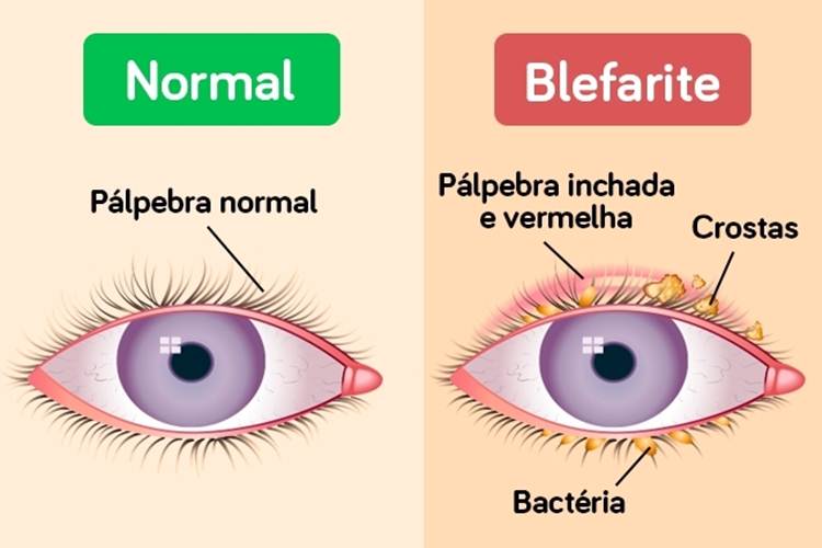 blefarite