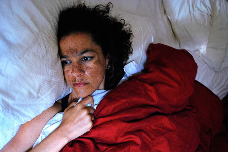 tipos-de-melasma-e-tratamentos